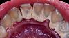 21 Yo Female S Teeth Tartar Removal Scaling Dentist Dokter Gigi Tri Putra